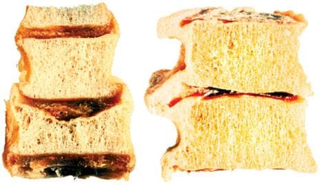 Измененные при остеопорозе позвонки и компрессионный перелом тела позвонка Измененные при остеопорозе позвонки и компрессионный перелом тела позвонка