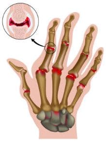 Излюбленная локализация воспаления на кисти при ревматоидном артрите Излюбленная локализация воспаления на кисти при ревматоидном артрите