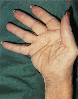 Деформация суставов кисти по типу «плавник моржа» Деформация суставов кисти по типу плавник моржа