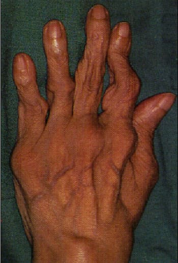 Деформация суставов кисти при ревматоидном артрите Деформация суставов кисти при ревматоидном артрите