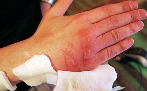 ожоги борщевик фото онлайн ожоги борщевик фото