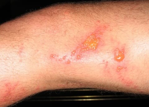 Ожоги от борщевика Ожоги от борщевика