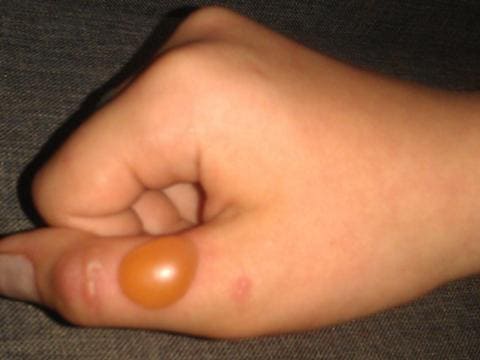 Ожоги от борщевика Ожоги от борщевика