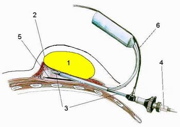 Эндоскопическое удаление липомы