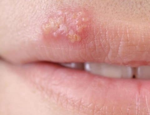 Лечение герпеса дендритными клетками