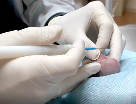 Пластика уздечки крайней плоти полового члена Пластика уздечки крайней плоти полового члена