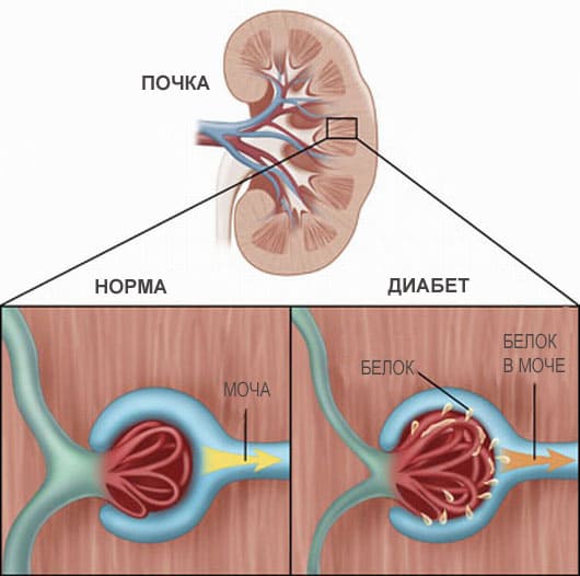 Поражение сосудов почек при диабете