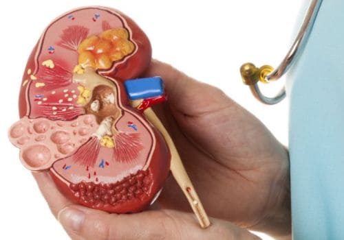 Гидронефроз Гидронефроз