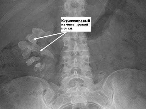 Рентгенография, коралловидный камень почки