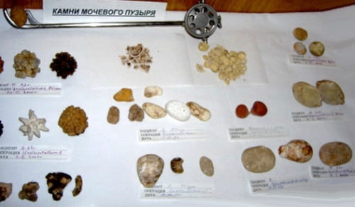 Мочекаменная болезнь (уролитиаз) Мочекаменная болезнь (уролитиаз)
