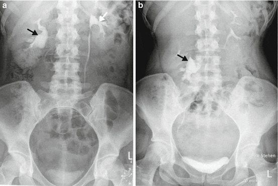 Нефроптоз (блуждающая почка) Нефроптоз (блуждающая почка)