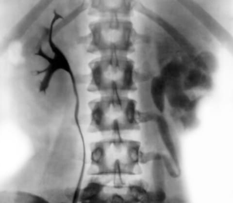 Туберкулез мочеполовой системы (нефротуберкулез)