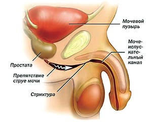 Стриктуры и облитерации мочеиспускательного канала