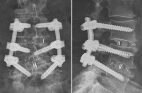 Транспедикулярная система TangoRS L3-L5 и спондилодез кейджами Pezo –T в сегменте L4-L5 Транспедикулярная система TangoRS L3-L5 и спондилодез кейджами Pezo –T в сегменте L4-L5
