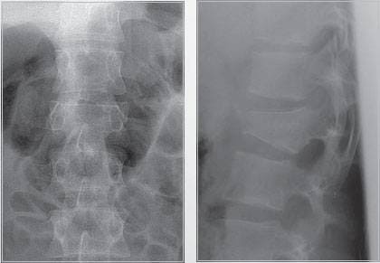 Перелом тела L2 Перелом тела L2