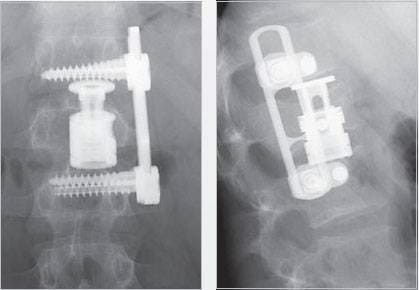 Передний спондилодез L1-L3 с замещением тела L2 имплантом Obelisc Передний спондилодез L1-L3 с замещением тела L2 имплантом Obelisc
