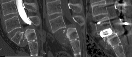 Спондилоптоз L5. Двухэтапная операция - резекция тела L5 и фиксация пояснично-крестцового отдела (L3-L4-S1) системой CDI и TSRH, межтеловой спондилодез L4-S1 кейджами Interfix. Задний спондилодез. Спондилоптоз L5. Двухэтапная операция - резекция тела L5 и фиксация пояснично-крестцового отдела (L3-L4-S1) системой CDI и TSRH, межтеловой спондилодез L4-S1 кейджами Interfix. Задний спондилодез.