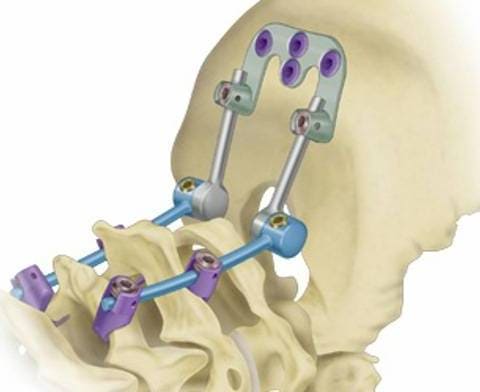 Реконструктивная система Vertex Select Реконструктивная система Vertex Select