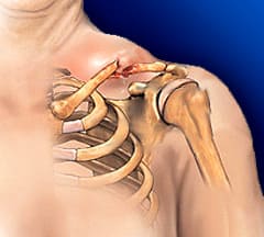 Перелом ключицы