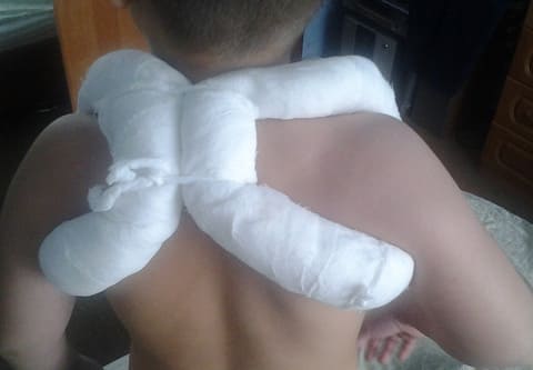 Перелом ключицы