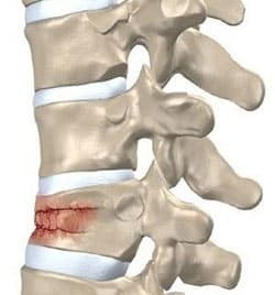 Перелом позвоночника