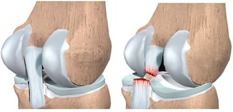Разрыв коленных (крестообразных) связок
