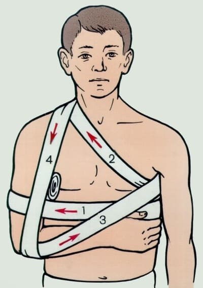 Вывих ключицы