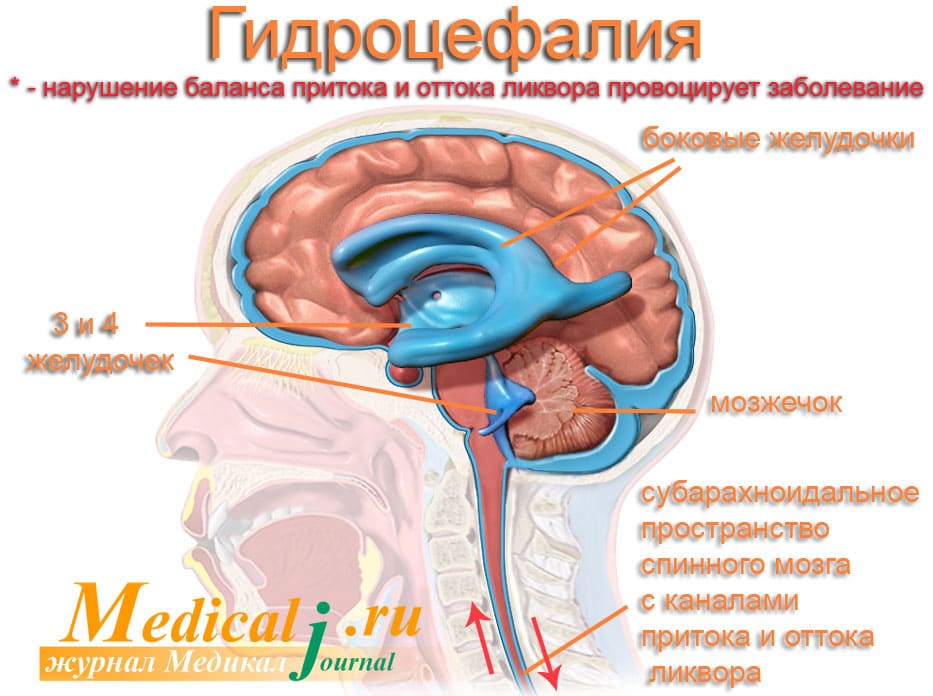 возникновение гидроцефалии