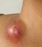 Нагноение лимфоузла Нагноение лимфоузла