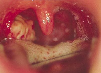 Ангина Ангина