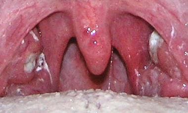 Тонзиллит Тонзиллит