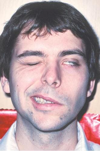 Невропатия лицевого нерва (паралич Белла, прозоплегия) Невропатия лицевого нерва (паралич Белла, прозоплегия)