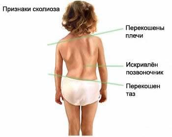 Признаки сколиоза Признаки сколиоза