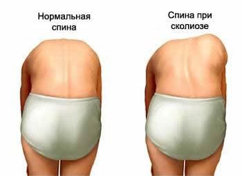 Признаки сколиоза Признаки сколиоза