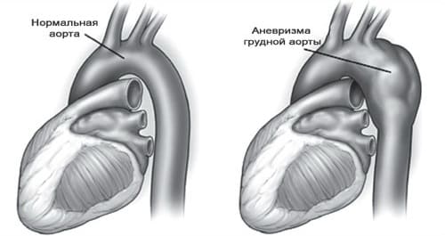Что такое аневризма аорты сердца
