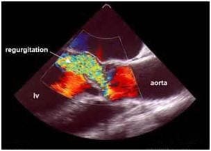 Аортальная недостаточность (недостаточность аортального клапана) 