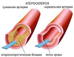 Атеросклероз