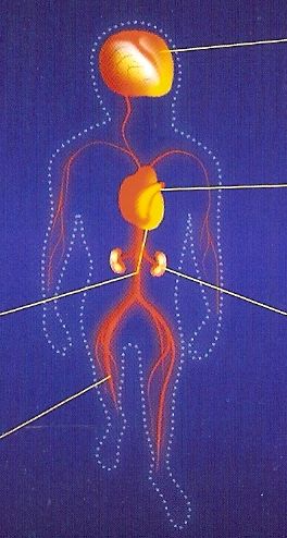 Поражение атеросклерозом Поражение атеросклерозом