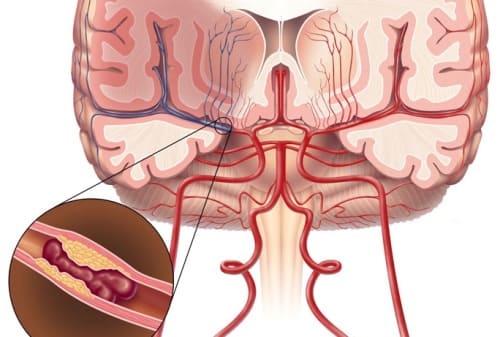 Атеросклероз сосудов головного мозга (церебральный) Атеросклероз сосудов головного мозга (церебральный)