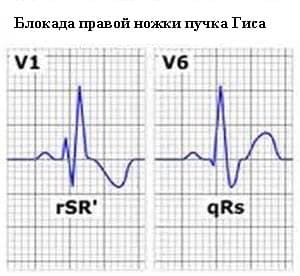 Блокада ножки пучка гиса на экг