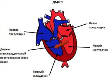 Дефект межжелудочковой перегородки 