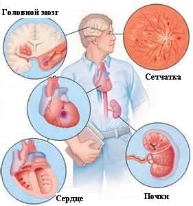 Эссенциальная (первичная) гипертензия