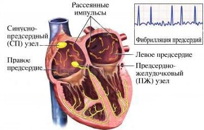 Фибрилляция предсердий