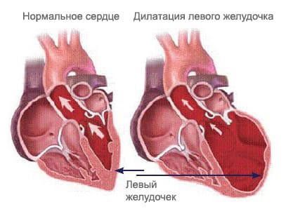 Хроническая сердечная недостаточность