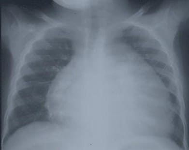 Хроническая сердечная недостаточность