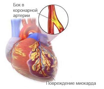 Кардиосклероз - Причины, симптомы и лечение Кардиосклероз - Причины, симптомы и лечение