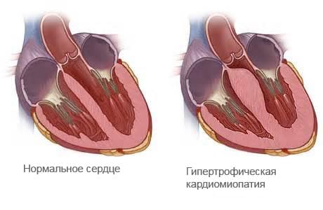 Кардиосклероз - Причины, симптомы и лечение Кардиосклероз - Причины, симптомы и лечение