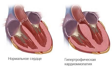 Кардиосклероз