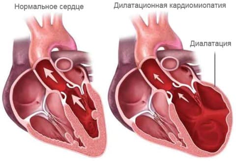Кардиосклероз - Причины, симптомы и лечение Кардиосклероз - Причины, симптомы и лечение