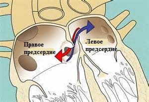 Овальное окно в сердце у взрослых